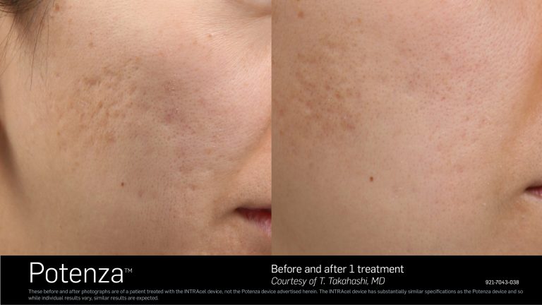 Potenza Before and After