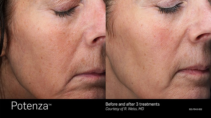 Potenza Microneedling Before and After