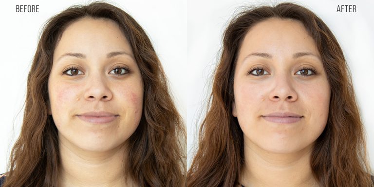 HydraFacial Before & After