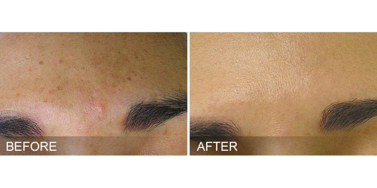 HydraFacial Before & After Brown Spots