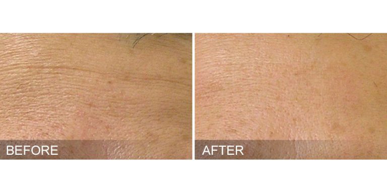 HydraFacial Before & After Fine Lines