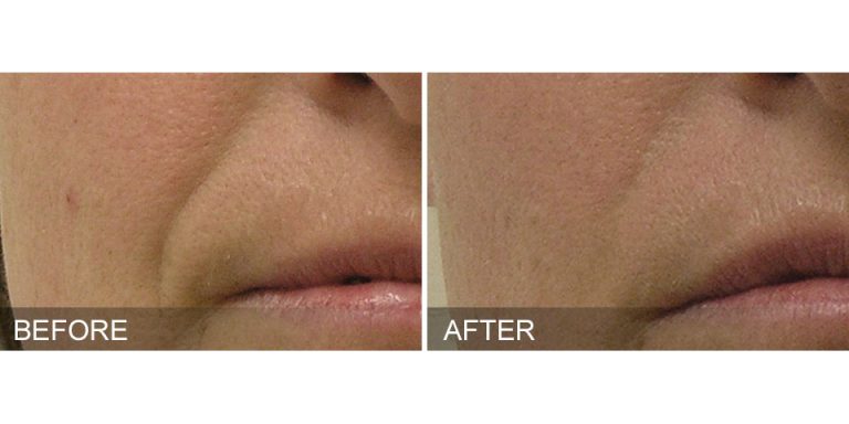 HydraFacial Before & After Nasolabial Folds