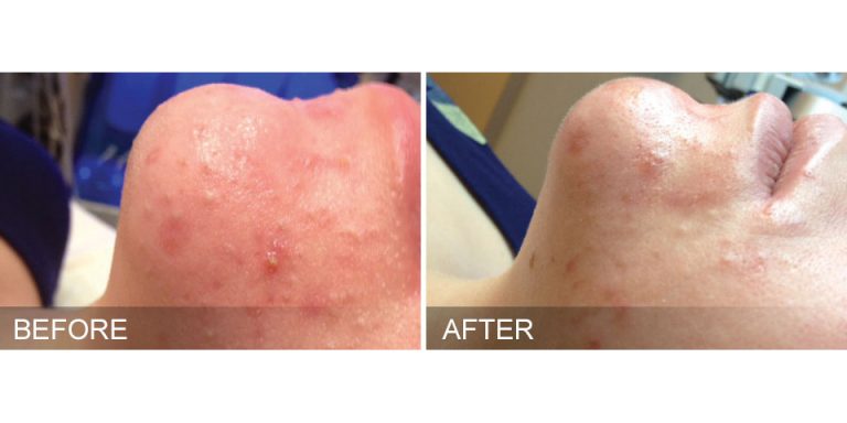 HydraFacial Before & After