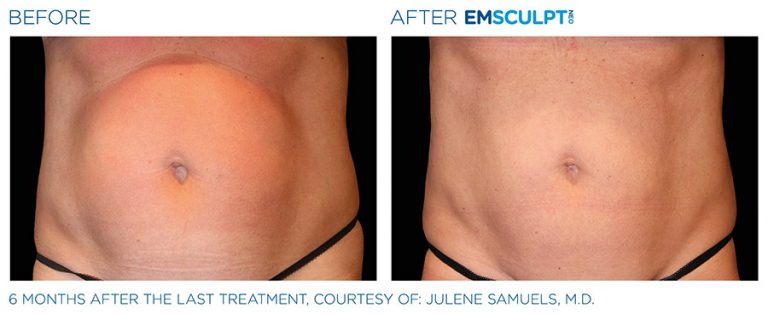 EMSCULPT NEO Before and After