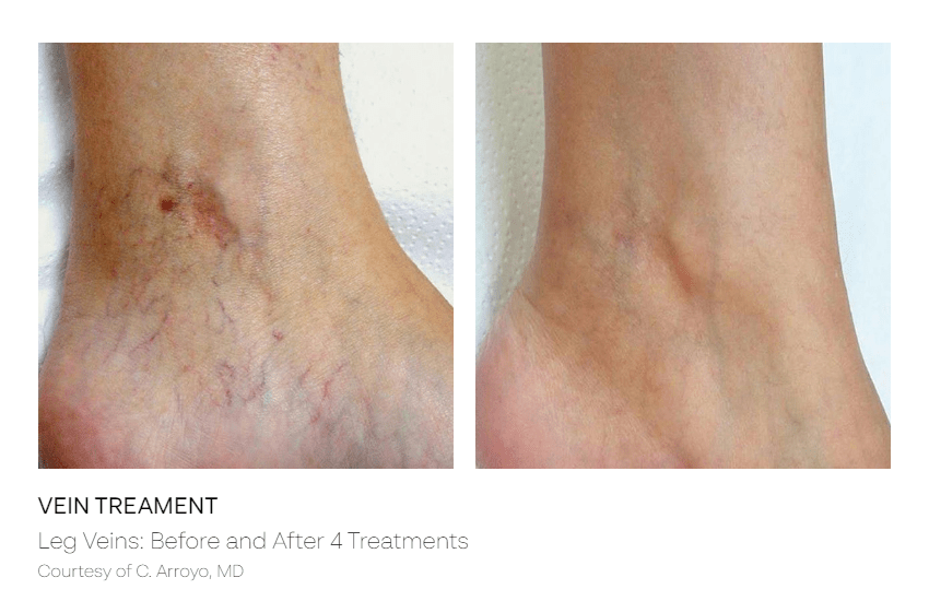 Spider Vein Treatment - B&A 1