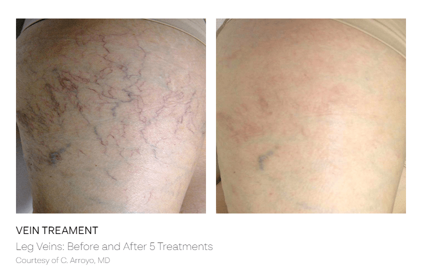 Spider Vein Treatment - B&A 2
